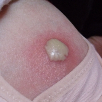 乳房上红肿起脓包是怎么回事?
