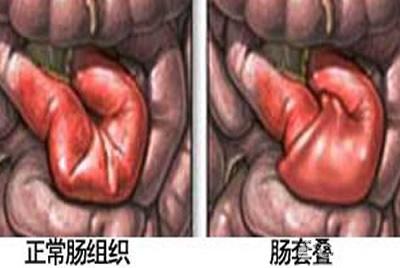 【育娃宝典】小儿肠套叠?这五大信号告诉你