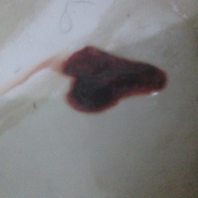 怀孕初期 有褐色分泌物 之后有一次肚子疼 流了一点红色的 然后就一直