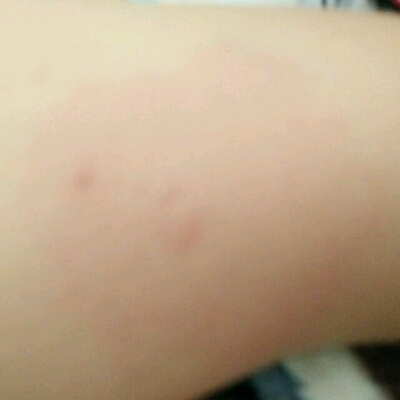 宝宝昨天打了百白破疫苗,晚上发烧了并且手臂处还有红红的硬块,今天不