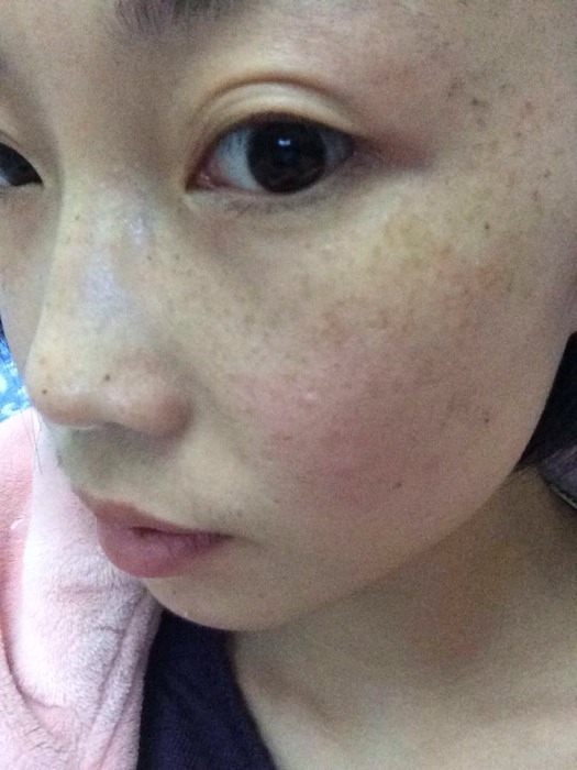 产后长斑_孩子现在10个月了,脸上好多斑,咋么办?圈里