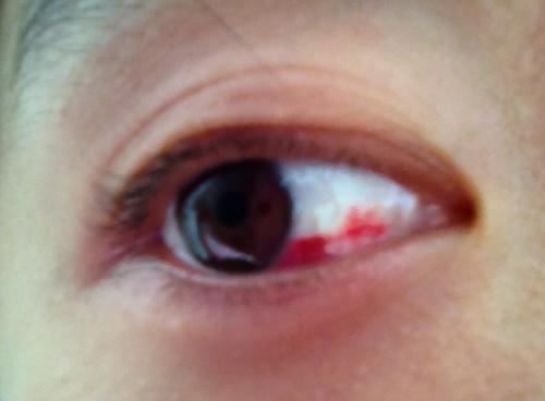 眼白出血了 不想去医院 有图慎入 宝宝树