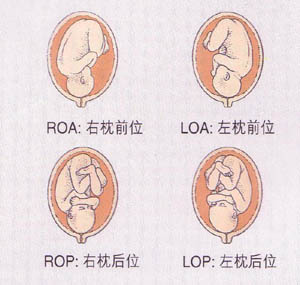 lop胎位图片