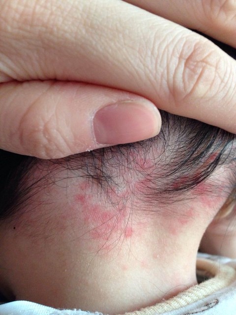 这是什么是鹤吻纹么?还是热的捂的