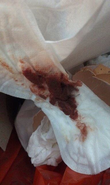 怀孕35天……出血