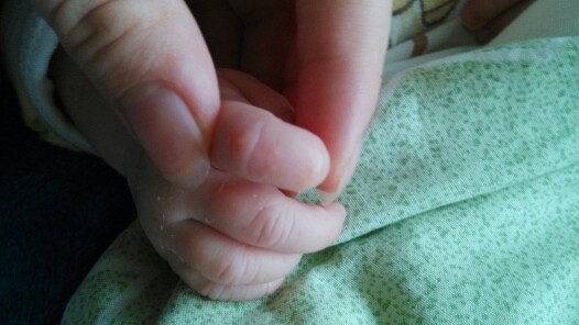 帮忙看看宝宝手指上长的小水泡是什么