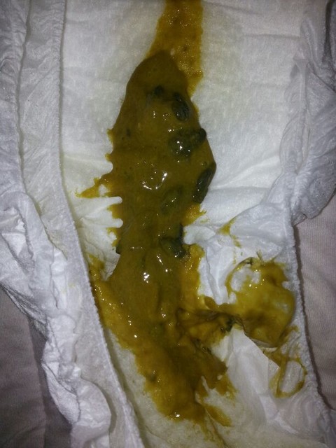 宝宝换了雅培奶粉后拉便便的症状