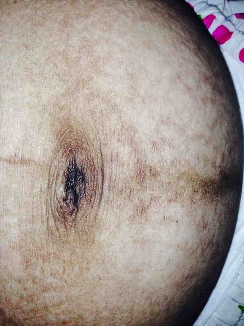 产后的肚子,剖腹产有图