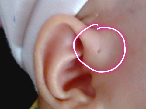 耳廓上有个小洞图片