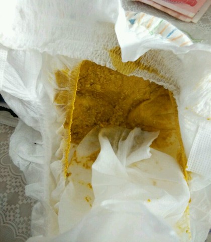 宝宝大便有粘液,是不是肠炎?