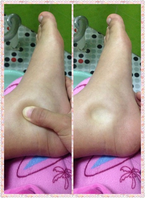 腿脚都肿了脚还有点疼 怎么缓解不适?