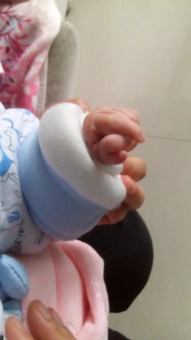 宝宝六指怎么办?