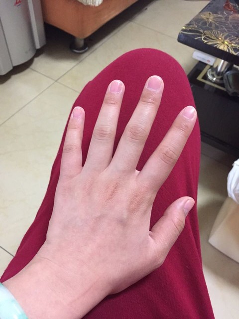 孕晚期手肿的关节痛,有什么好方法解决吗?