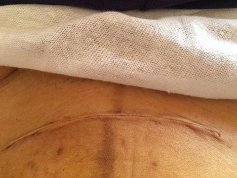 剖腹产后正常刀口图图片