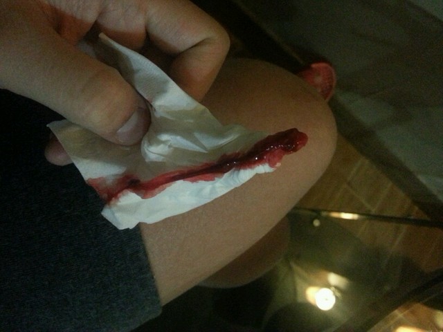 孕晚期时不时流鼻血的宝妈有木有?