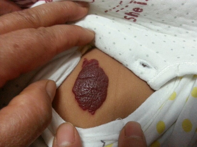 血管肉瘤早期症状图片