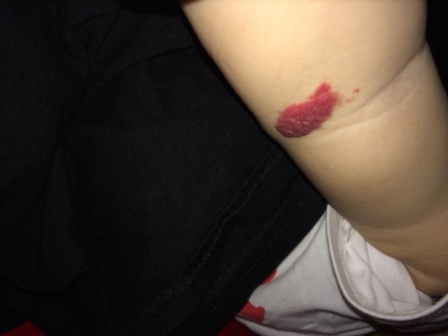 育儿经验:婴儿胎记血管瘤