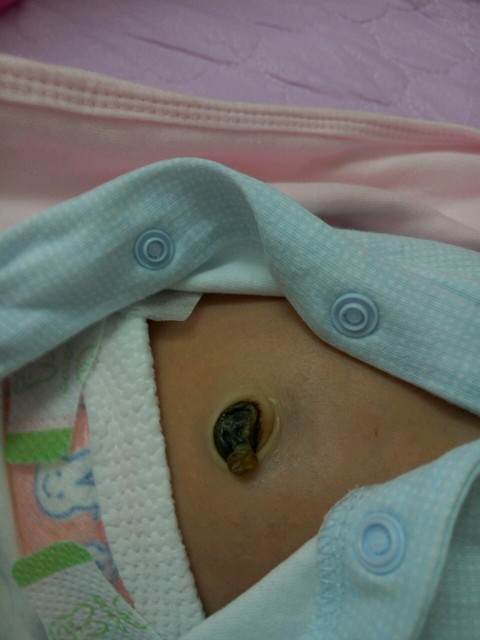 宝宝脐带怎么还不掉!_宝宝(男孩)19号顺产,胶带今天还_宝宝树