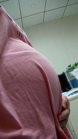 孕妇肚脐外翻图片