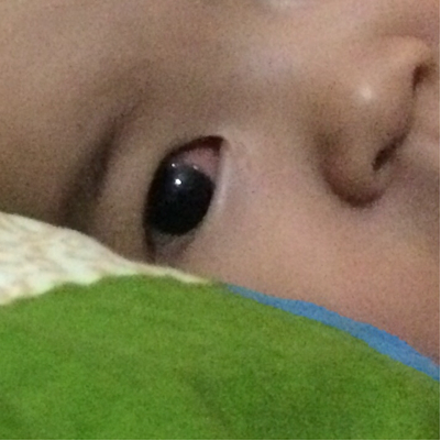婴儿眼白有红血斑图片图片