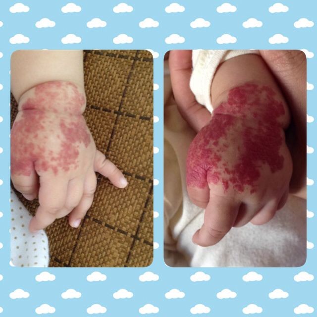 婴儿血管瘤早期症有哪些?