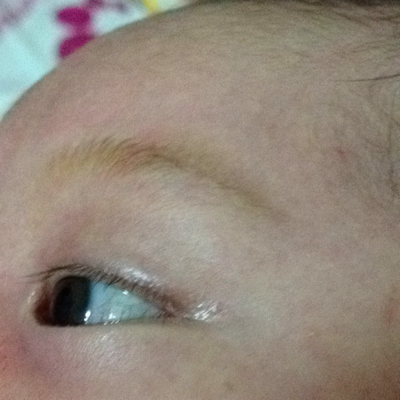宝宝的一只眼睛好多红血丝,不知道怎麼回事
