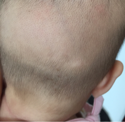 六个多月的女宝后脑勺这几天露出一小块白色的头皮,之前长得有头发