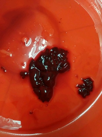 怀孕40天,大出血,大血块