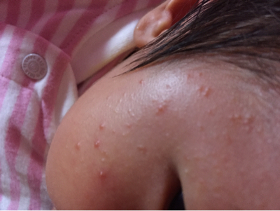 宝宝23天,母乳餵养,前天开始脸上长了很多这样的痘痘,需要去就诊吗