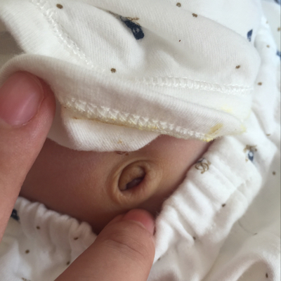 宝宝脐带掉了之后,肚脐眼有一小块白色的,看上去湿湿的是怎麼回事?
