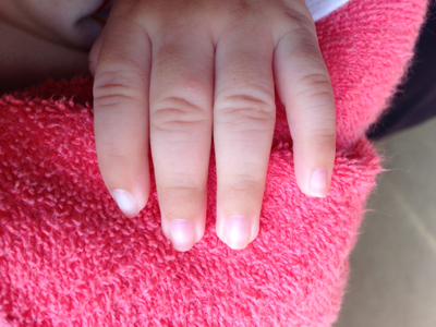 宝宝指甲下皮肤黝黑一点是怎麼回事?每个手指都有,感谢