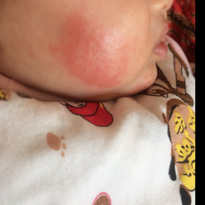 婴儿湿疹消退过程图片图片