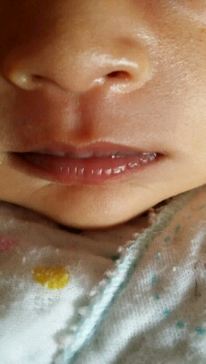 宝宝肺炎嘴唇发紫图片图片