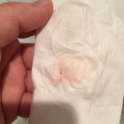 孕七周,刚刚上厕所有一点血丝,其他没有任何不适