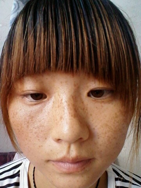产后很多的妊娠斑呢,怎么办?