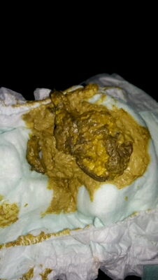 宝宝两天没拉大便,刚拉出来就是这个样子?