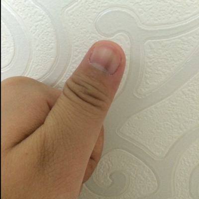 孕六个多月,发带状疱疹,指甲莫名其妙长了道黑线,这是黑指甲吗?
