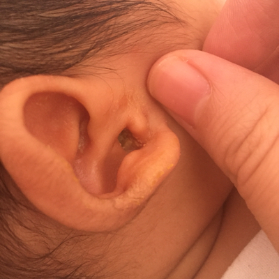 哪位宝妈知道这是怎麼啦,刚刚突然发现小宝耳朵里有分泌物,外耳道上