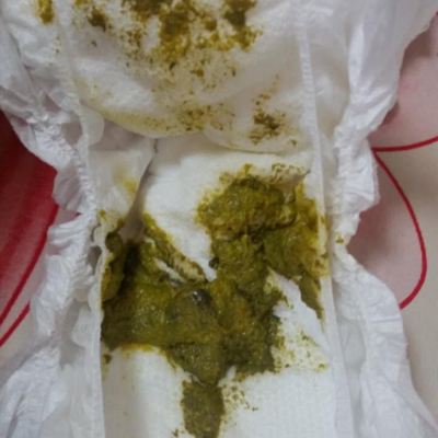 宝宝这两天老是拉这种大便,请问是怎麼了,谢谢