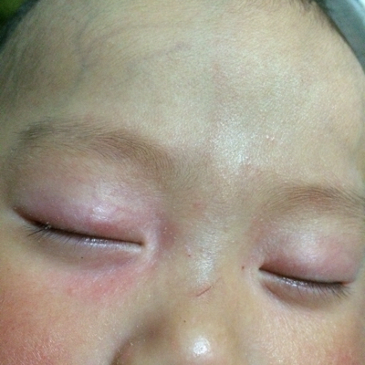 宝宝眼睛周围湿疹图片图片