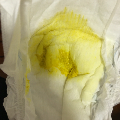 一喝母乳就拉肚子,现在十六天,一天能拉十多次,颜色金黄色,水便分离