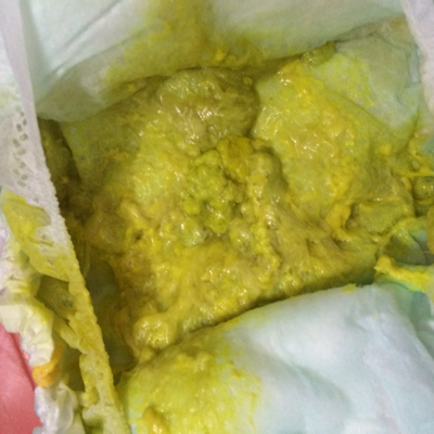 宝宝大便味道腐臭,像鸡蛋羹,会呕吐是怎麼了