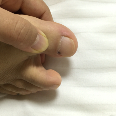 黑素瘤脚指甲图片