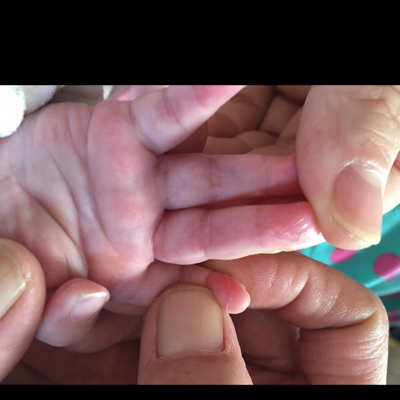 宝宝手指肚红图片图片