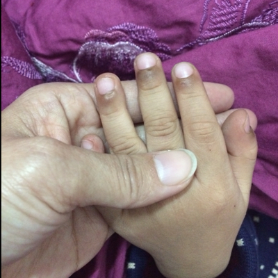 有懂得看的宝妈帮忙一下,4岁的小孩指甲边缘的皮肤很黑,是什麼原因