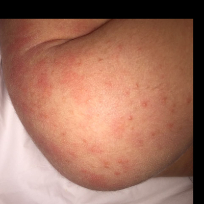 宝宝出生两天. 吐奶.身上长的是什麼有知道的吗