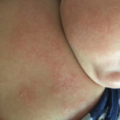 昨天给宝宝洗澡,发现湿疹又严重了.湿疹总反覆怎麼办?