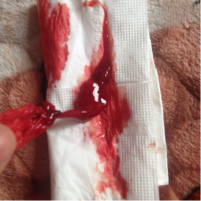 每次流鼻血这种想鼻涕一样的东西出来以后就不会流了.请问为什麼阿.