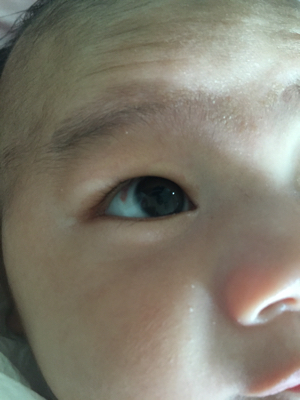三个月宝宝眼皮红图片图片