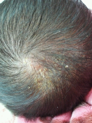 宝宝后脑勺有黄咖怎麼办